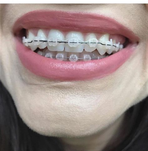 Clear Braces Ceramics, Braces Aesthetic, Dental Braces Colors, Teeth Whitening Led, Teeth Whitening Mouthwash, Lingual Braces, Ceramic Braces, Cute Braces Colors, Braces Tips