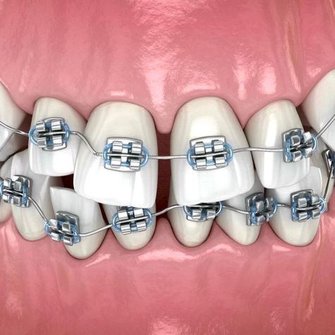 Orthodontics Marketing, Orthodontics Teeth, Damon Braces, Dental Wallpaper, Dental Advertising, Misaligned Teeth, Dental Images, Dental Posters, Dental Aesthetics