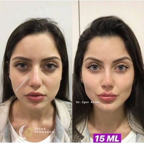 Cosmetic Insider’s Instagram profile post: “Before/after non surgical facial rejuvenation with 15 mLs. What do you think? Comment ⬇️ . . This work was done by @igoorcostalves . . This…” Nose Fillers, Botox Brow Lift, Under Eye Fillers, Botox Before And After, Face Fillers, Eyebrow Lift, Botox Cosmetic, Botox Face, Cheek Fillers