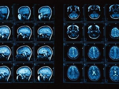 Brain Pictures, Brain Surgeon, Brain Images, Brain Diseases, Brain Scan, Mri Scan, Magnetic Resonance Imaging, Magnetic Resonance, Medical Aesthetic