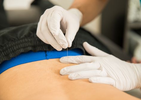 What is Myofascial Trigger Point Dry Needling? | MyHealth1st Dry Needling Trigger Points, Needling Therapy, Dry Needling Therapy, Referred Pain, Pelvic Organ Prolapse, Muscle Twitching, Dry Needling, Muscle Knots, Pelvic Pain