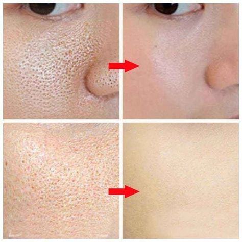 Pore Refining Serum https://mariaochoarussell.store/products/pore-refining-serum BigDrop #Bestseller Kids Fashion Wear, Pore Minimizer, Acne Scar, Skin Detox, Facial Peel, How To Get Rid Of Acne, Minimize Pores, Face Primer, Aloe Vera Gel