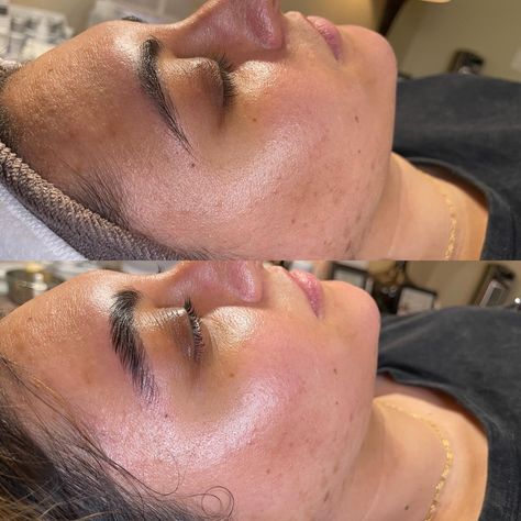 Skin Before And After, Dermaplane Facial, Facial Before And After, Brow Lift, Brow Lamination, Brow Shaping, Layers Of Skin, Lash Lift, The Glow