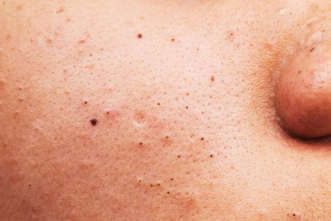 What Causes Blackheads, Removing Blackheads, Mild Acne, Blackhead Remedies, Types Of Acne, Get Rid Of Blackheads, Mascara Facial, How To Get Rid Of Acne, Moisturizer For Dry Skin