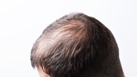 Androgenic Alopecia is the most common condition associated with the need for hair loss treatments and is one that is quite prevalent in all men. Androgenic Alopecia, Hair Restoration, For Hair, Close Up, Hair Hair, Conditioner, Wall, Hair, White