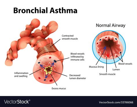 Asthma Illustration, Parathyroid Gland, Bronchial Asthma, Heart Logo, Medical Education, Blood Vessels, Anatomy, Adobe Illustrator, Stock Vector