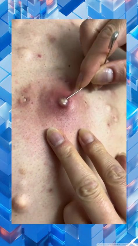 Espinhas 14 Satisfying Pimple Videos Popping, Cysts Popping Videos, Pimple Poppìng Videos, Acne Popping, Pimple Poppìng, Big Zits, Satisfying Zit Popping Videos, Squeezing Blackheads, Pimple Popper Tool