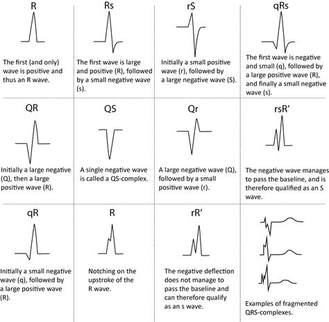 ECG interpretation: Characteristics of the normal ECG (P-wave, QRS complex, ST segment, T-wave) – ECG learning Nursing Cardiac, Normal Ecg, Ekg Rhythms, Ekg Interpretation, Ecg Interpretation, Paramedic School, Medical Mnemonics, Medical Notes, P Wave