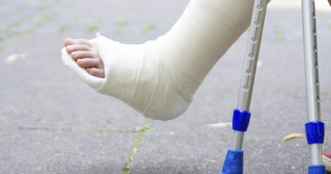 If you have injured your ankle, resulting in a severe sprain or fracture, you may need to wear a cast to keep it immobilized while it heals. Stanford School of Medicine explains that a cast is made of either plaster or fiberglass, which encompasses the injury during the healing process. In the case of an ankle injury, a cast may be worn anywhere... Broken Ankle Recovery, Walking Cast, Fracture Healing, Ankle Exercises, Swollen Ankles, Broken Ankle, Cardio Exercise, Bad Knees, Foot Injury