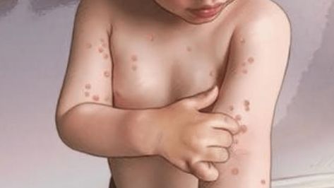 HOW TO GET RID OF MOLLUSCUM CONTAGIOSUM FAST - Just Live Cause Molluscum Contagiosum, Just Live, More And More, My Daughter, Home Remedies, Bump, Let Me, Lifestyle