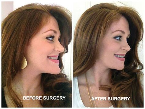 Upper Jaw Surgery, Chin Reduction Surgery, Perfect Teeth Braces, Chin Reduction, Double Jaw Surgery, Jaw Reduction Surgery, Teeth Aesthetic, Reduction Surgery, Jaw Surgery