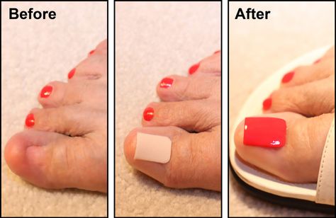 New Invention. Cosmetic adhesive wrap to conceal a damaged or missing toenail. Polish and apply like a bandage. Watch 1 minute application video at www.AppealingWhileHealing.com Toenail Tattoo Missing, Toenail Ideas, White Toes Nail, Ten Nails, Acrylic Toes, How To Crochet For Beginners, Acrylic Toe Nails, Fungal Nail, How To Shade