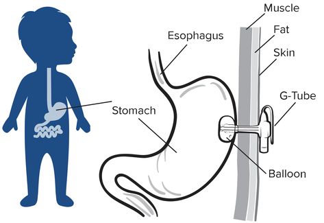 Gastrostomy Tube, Peg Tube, Rett Syndrome, Pediatric Surgery, School Nursing, Uc Davis, Patient Education, Feeding Tube, Emergency Room