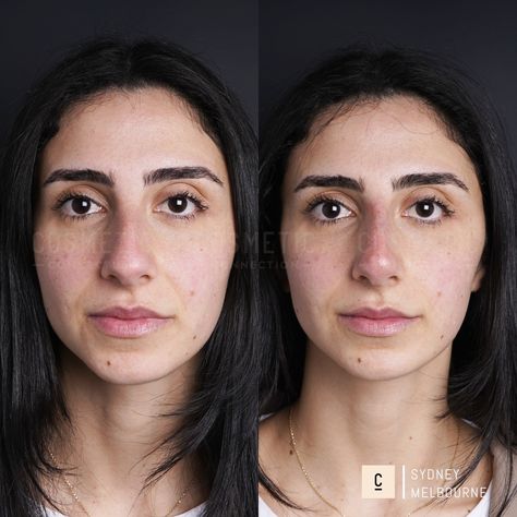 Our non-surgical rhinoplasty is a 15-minute injectable procedure that immediately improves the appearance of your nose. It’s a highly effective solution that can: - Hide bumps and humps - Lift and refine your nose tip - Slim and define your nose bridge - Balance the shape and size of your nose - Straighten a crooked nose - Improve poor surgical rhinoplasty results ⁠ Did you love this result? Want to know if it's right for you? Comment 'NOSE' to claim your complimentary opinion. ⁠⁠⁠ This con... Nose Tip, Crooked Nose, Nose Bridge, Bridge