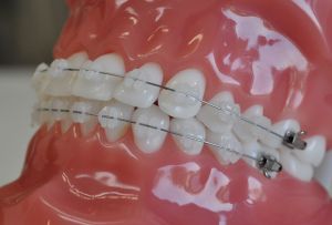 Porcelain Braces, Braces Ideas, Dental Bridge Cost, Braces Cost, Clear Braces, Brace Face, Teeth Whitening Toothpaste, Braces Colors, Dental Braces