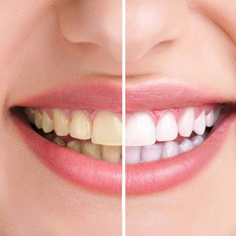 Teeth Whitening at Jamnagar Dr. Bharat Katarmal Dental Bleaching, Aesthetic Dentistry, Teeth Braces, Implant Dentistry, Dental Veneers, Skin Spots, Natural Teeth Whitening, Natural Teeth, Health Skin Care