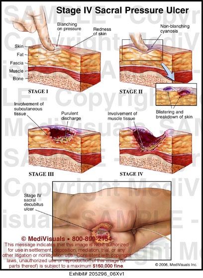 Pressure ulcer stages Pressure Ulcer Staging, Wound Care Nursing, Nurse Teaching, Nursing Assessment, Bed Sores, Pressure Ulcer, Nursing Mnemonics, Nursing School Survival, Nursing School Studying