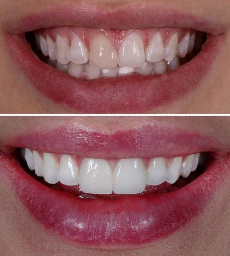 How to whiten teeth naturally at home Grow Back Receding Gums, Whiten Teeth Fast, Pretty Teeth, Veneers Teeth, Teeth Whitening Remedies, Beautiful Teeth, Laser Teeth Whitening, Whiten Teeth, Porcelain Veneers