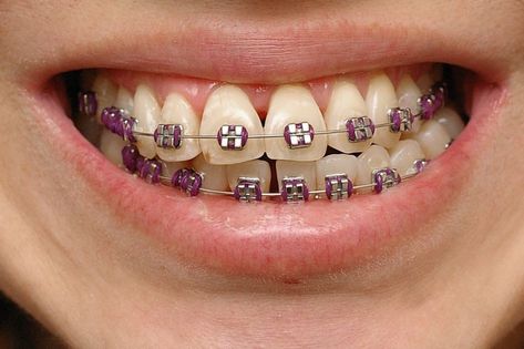 Braces Types, Brace Colors, Purple Braces, Cute Braces Colors, Teeth Aesthetic, Types Of Braces, Adult Braces, Kids Braces, Braces Tips