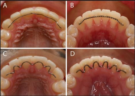 What is a permanent retainer? A fixed retainer, also known as a permanent or bonded retainer, is a wire that is glued to the lingual (tongue side) of the teeth. Contact to best orthodontist for Bonded Retainer or Replacement Retainer. Black Hair Quick Weave, Permanent Retainer, Retainer Teeth, Future Dentist, Dental Hygiene Student, Orthodontic Appliances, Dental Videos, Dental Hygiene School, Brace Face