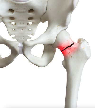 An osteoporotic fracture occurs every three seconds worldwide. With more than 50 per cent of the world's hip fractures expected to occur in the Asia Pacific (AP) region over the next two decades, the Asia Pacific Consortium on Osteoporosis (APCO) has launched a Bone Health QI Tool Kit today (May 24, 2022), to promote quality improvement (QI) of osteoporosis care. Hip Fracture, Quality Improvement, Bone Health, Tool Kit, Product Launch, Health