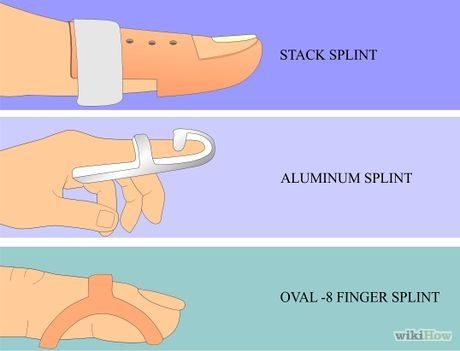 Surgical Art, Hand Splint, Nbcot Exam, Mallet Finger, Rehabilitation Equipment, Sports Massage Therapy, Infant Lesson Plans, Finger Splint, Finger Exercises