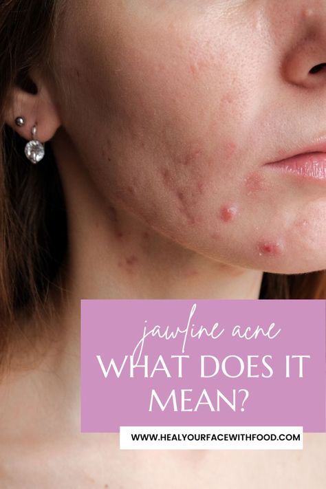 How do you treat jawline acne? What causes jawline acne in the first place? Today I'm sharing the main causes for jawline acne + how to clear cystic acne on your jawline fast! Have you tried any of these action steps? Did they work? Comment below with what you've tried! Acne On Jawline, For Jawline, Jawline Acne, Clear Skin Tips, Cystic Acne, Clear Acne, Skin Tips, First Place, Have You Tried