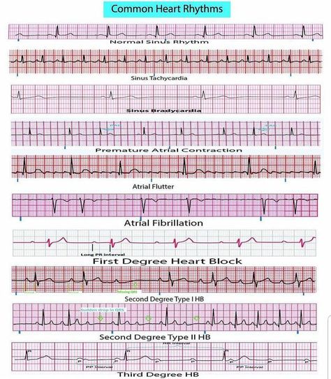 A comprehensive field reference for 12 lead EKG interpretation Field Reference, Ekg Nursing, Cardiothoracic Surgeon, Ekg Rhythms, Fitness Assessment, Cardiology Nursing, Ekg Interpretation, Ecg Interpretation, Cardiac Rhythms