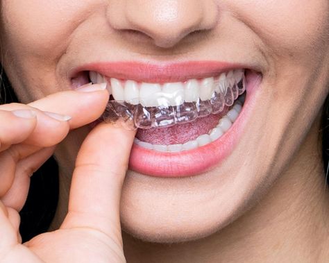 bestsmile Aligner I invisible braces made in Switzerland Transparent Braces, Braces Clear, Lingual Braces, Ceramic Braces, Invisalign Braces, Teeth Alignment, Denture Implants, Invisible Braces, Traditional Braces