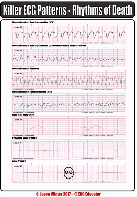 Neonatal Nursing, Paramedic School, Nursing Mnemonics, Neonatal Nurse, Cardiac Nursing, Nursing School Survival, Critical Care Nursing, Nursing School Studying, Nursing School Tips