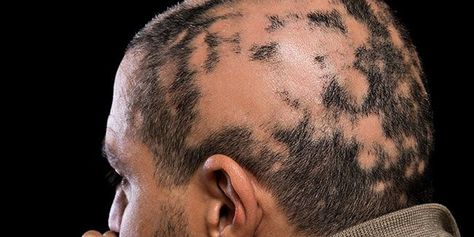 alopecia areata facts Alopecia Symptoms Signs, Alopecia Photography, Alopecia Causes, Alopecia Hairstyles, Scalp Micropigmentation, Vip Lounge, Hair Remedies For Growth, Pattern Baldness, Regrow Hair