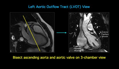 cardiac mri | MRI BLOG: Cardiac MRI - Imaging Planes for Basic Cardiac Views Cardiac Cycle, Heart Anatomy, Congenital Heart, Magnetic Resonance Imaging, Coronary Arteries, Rad Tech, Magnetic Resonance, Medical Imaging, Medical Anatomy