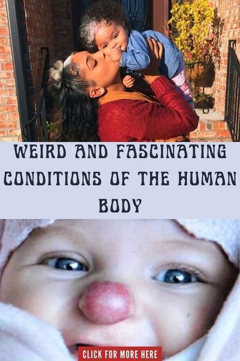 Weird and Fascinating Conditions of the Human Body Kueez Viral, Kueez Pins, Body Condition, Human Condition, The Human Body, Viral Trend, Skin Conditions, Study Motivation, Viral Pins