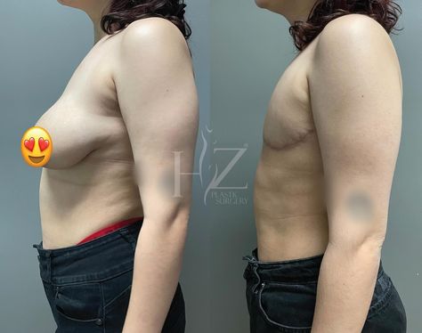 Top surgery results at 3 months post-op ✨ Our patient wanted to achieve a flat chest and requested to have no nipples, so @drzhzps performed a partial mastectomy and our patient is healing beautifully! 𝐏𝐫𝐞-𝐎𝐩 𝐒𝐭𝐚𝐭𝐬: Age: 20, Height: 5ft 4in, Weight: 160lbs, BMI: 27 𝐃𝐞𝐭𝐚𝐢𝐥𝐬: ✨ By @drzhzps 🥼 Board-certified surgeon 📲 Virtual + in-person consults 💵 Financing + layaway available 🧐 Unlock pricing (link in bio) 🌴 Orlando, FL 𝐁𝐨𝐨𝐤 𝐲𝐨𝐮𝐫 𝐜𝐨𝐧𝐬𝐮𝐥𝐭𝐚𝐭𝐢𝐨𝐧 🗓️ Schedule a virtual or in-person consultatio... Plus Size Top Surgery, Nonbinary Top Surgery, Top Surgery Results, Trans Scar Tattoo, Partial Mastectomy, Post Top Surgery, Patient Care Coordinator, Mastectomy Scars, Gender Euphoria