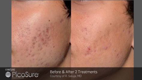 Acne scar removal beauty skincare Picosure Tattoo Removal, Laser Acne Scar Removal, Cell Signaling, Pico Laser, Laser Skin Resurfacing, Severe Acne, Acne Scar Removal, Skin Resurfacing, Laser Tattoo Removal