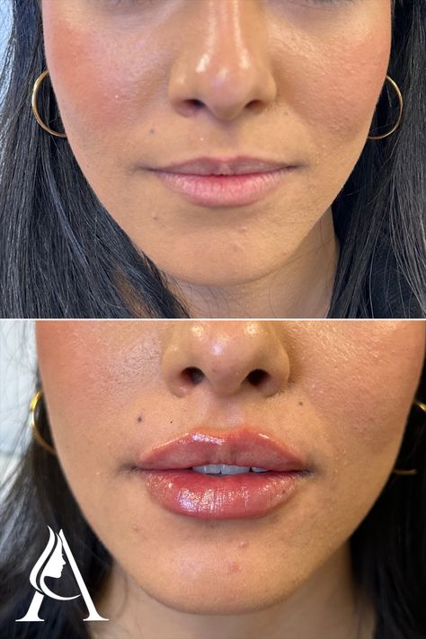 Lips before and after - we're OBSESSED with this first-time lip filler transformation!

Restylane Kysse lip filler in Philadelphia, PA. 

Book a consultation with our amazing injectors at Ari Blanc Medical Spa for your own lip makeover! Filler Transformation, Lip Fillers Juvederm, Saggy Cheeks, 1ml Lip Filler, Restylane Lips, Dermal Fillers Lips, Hyaluronic Acid Lips, Lips Inspiration, Face Fillers