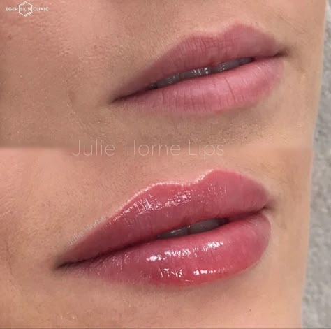 Injector Nurse, Lip Fillers Juvederm, Restylane Lips, Lip Job, Dermal Fillers Lips, Lips Inspiration, Botox Lips, Facial Fillers, Facial Contouring