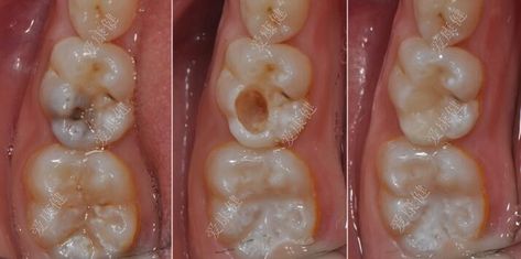 If your filling falls out your tooth can you just leave it? For treating cavities most patients choose a filling, however when a filling falls out most patients ask what’s the best way to treat it? Is it best just to leave it? Root Canal Procedure, Dental Notes, Perfect Smile Teeth, Cavity Filling, Dental Education, Braces Tips, Tooth Filling, Dental Fillings, Dental Cavities