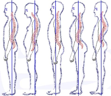 Sway Back Posture, Rounded Shoulder Exercises, Strengthen Hip Flexors, Strengthen Hips, Lumbar Lordosis, Anterior Pelvic Tilt, Rectus Abdominis Muscle, Posture Fix, Sway Back