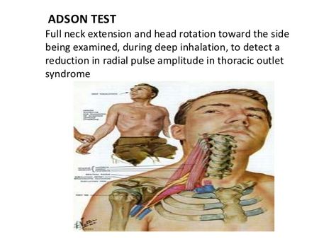 ADSON TESTFull neck extension and head rotation toward the sidebeing examined, during deep inhalation, to detect areductio... Thoracic Outlet, Brachial Plexus, Medical Massage, Medical Training, Muscle Anatomy, Hand Therapy, Therapeutic Massage, Vintage Medical, Activity Ideas