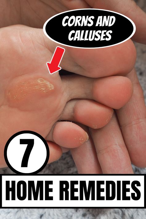 Nail Infection Remove Calluses On Feet Remedies, Diy Callus Remover, How To Remove Calluses From Foot, Calloused Feet Remedy, How To Get Rid Of Calluses On Feet Fast, Calluses On Feet Remedies, Foot Soak For Calluses, Callus Remover Diy, Get Rid Of Corns