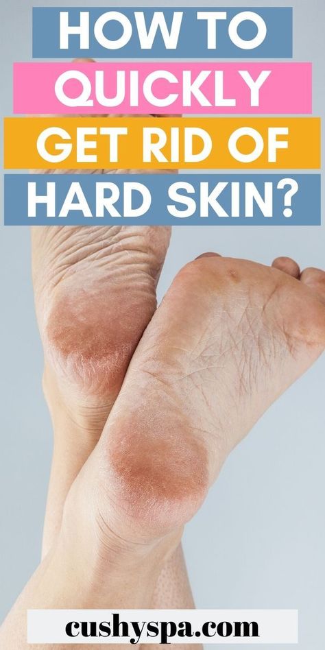 Try these tips to get rid of hard skin on feet that can get so annoying! Say goodbye to calluses, hard skin and finally take a good care of your feet. Homemade Foot Cream, Cracked Heel Remedies, Foot Soak Recipe, Dry Heels, Uses For Vicks, Hand And Foot Care, Diy Kosmetik, Foot Soak, Thick Skin