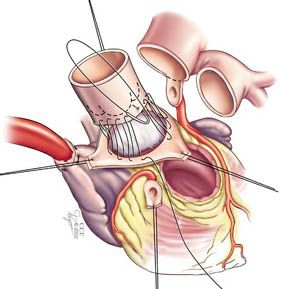 Cardiac Ultrasound, Aortic Valve Replacement, Heart Valves, Open Heart Surgery, Heart Care, Congenital Heart, Coronary Arteries, Heart Surgery, Work Project