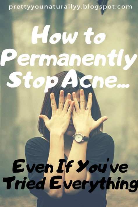 Here are my top 5 tips to clear acne and get healthy and clear skin fast. These tips I have learnt over the past few years that have helped me transform my skin... Dark Marks On Face, Under Eye Lines, Acne Hacks, How To Clear Pimples, Clear Skin Fast, Acne Clearing, Bad Acne, Pimples Remedies, Prevent Pimples