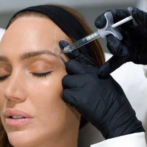 Temple Filler, Armonizacion Facial, Allergan Botox, Forehead Lines, Cosmetic Inspiration, Face Fillers, Frown Lines, Dental Photography, Botox Cosmetic