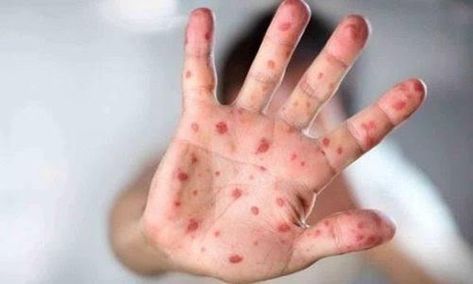 The virus could be a new variant of the viral hand, foot, and mouth disease or an after effect of Dengue or Chickengunya targeting mostly children aged 1–5 years and immunocompromised adults. The primary symptoms observed in children with tomato flu are similar to those of chikungunya, which include high fever, rashes, and intense pain in joints. Runny Nose, Public Health, Health Issues, Disease, Health, 10 Things