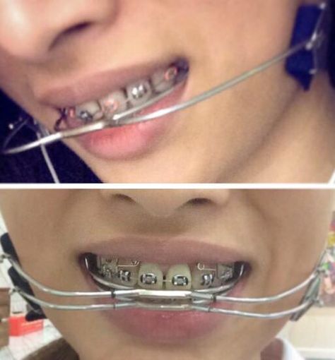 Headgear Braces, Braces Girl, Braces Girls, Orthodontic Appliances, Brace Face, Dental Braces, Perfect Teeth, Orthodontics Braces, Morning Humor