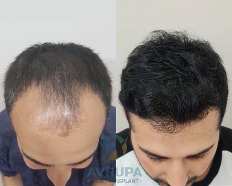 Before and after hair transplant in Turkey using the Sapphire FUE technique. Hair Transplant Before And After, Before And After Hair, Hair Transplant, Long Hair, Sapphire, Long Hair Styles, Hair Styles, Hair, Photography