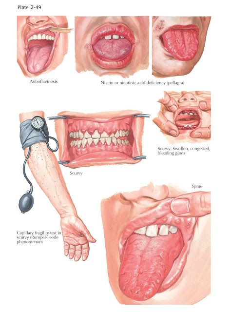 Oral Manifestations in Nutritional Deficiencies   The oral mucous membranes are exquisitely sensitive to nutritional deprivation; however... Dental Notes, Future Dentist, Oral Pathology, Remedies For Tooth Ache, Dental Hygiene School, Dental Technician, Dental Gifts, Dental Life, Dental Art