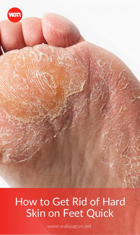 Peeling Skin On Feet How To Get Rid Of, Heel Callus Remover Diy, How To Get Rid Of Dry Skin On Feet Heels, How To Get Dry Skin Off Feet, How To Remove Dry Skin From Heels, Peeling Feet Remedy Diy, Dry Feet How To Get Rid Of, Coconut Oil For Feet Dry Skin, How To Get Rid Of Dry Feet Skin